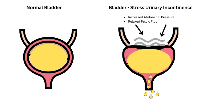 Stress Incontinence Bladder vs Normal Bladder